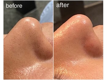 サロン ドゥ メビウス 春日店(salon de mebius)/毛穴☆ハイドラフェイシャル