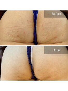 エミルカ(EMILUCA)/ハーブピーリングでお悩み改善