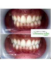 ホワイトニングサロン 名古屋駅店/【ホワイトニング施術例】
