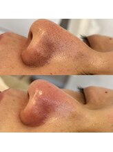 ノイ(Noi.)/Before-After