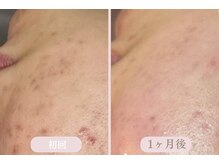 エピル(EPIL)/スキンケアセット症例