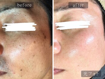 アムールサロン(Amour salon)/光フェイシャルでシミケア/新宿