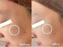 ブランシェ 金沢店 × 椿/シミケア　『30代お客様』