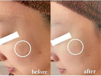 ブランシェ 金沢店 × 椿/シミケア　『30代お客様』