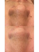 ディオーネ 春日井勝川店(Dione)/毛穴洗浄☆ビフォーアフター