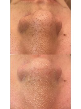 ディオーネ 春日井勝川店(Dione)/毛穴洗浄☆ビフォーアフター