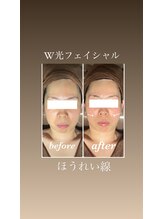 イーストモア(EAST MOIS)/リフトアップでほうれい線も薄く