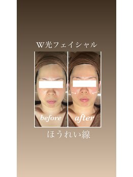 イーストモア(EAST MOIS)/リフトアップでほうれい線も薄く