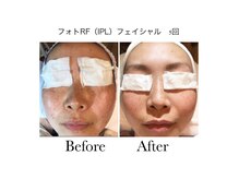 ビューティーサロン ルクール エステ(beauty salon le Coeur Este)の雰囲気（【フォトRF】シミ改善/ニキビケア/はり/毛穴収縮）