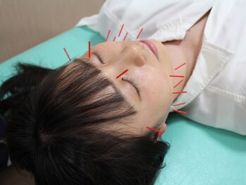 竹の塚トップ鍼灸接骨院の写真/【国家資格取得者が対応◎】あなたに合ったオーダーメイド美容鍼×指圧×整体でお身体の内側から綺麗に♪