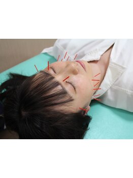 鍼灸施術を受けたい