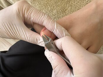 巻き爪ケア【STEP３】