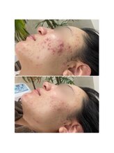 ニキビケア研究所 吉祥寺店/赤みを引かせたい・・