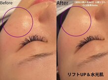 ミラ 中央林間(mira)/小顔　毛穴　ホワイトニング