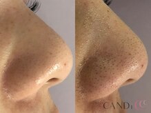 キャンディ 名古屋金山店(CANDi)/ハイドラピーリング黒ずみ毛穴◎