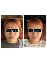 キュープ 福岡天神店(Qpu)/通常コース４回での変化