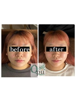 キュープ 福岡天神店(Qpu)/通常コース4回での変化