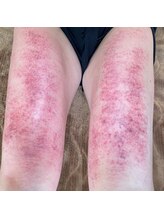 コル コルエ(koru korue)/太もも動かないとこうなる