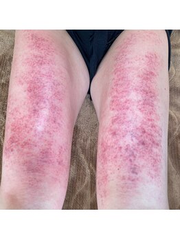 コル コルエ(koru korue)/太もも動かないとこうなる