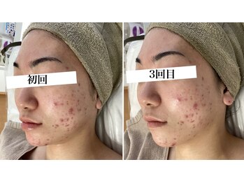 ホリシア 博多(HORISHIA)/ハーブピーリング/ニキビケア