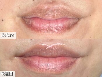 エモーショナル 姫路(Emotional)/ルメラ◎リップ2ヶ月