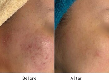 トータルビューティー ココ(Total Beauty CoCo)の写真/毛穴黒ずみ・繰り返すニキビ（跡）も徹底ケア！ピーリング&フェイシャルで透明感あふれるつるすべ肌へ