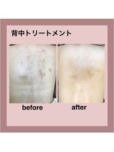 エステティック レイビス 秋田店(RAYVIS)/劇的！背中トリートメント