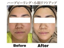 ティアム バイ テトテ 神戸三宮(TIAM by tetote)/ハーブピーリング