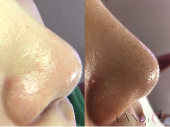 キャンディ 名古屋金山店(CANDi)/ハイドラピーリング黒ずみ毛穴◎