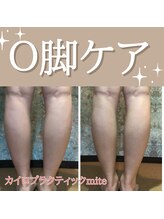 ミーテ(mite)/O脚やX脚のお悩みも