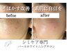 【シミ肌改善】小さいたくさんあるシミのケアし放題ケア×ホワイトニング8800