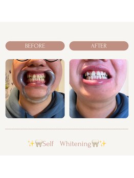 サロンエピ(Salon Epi)/セルフホワイトニング