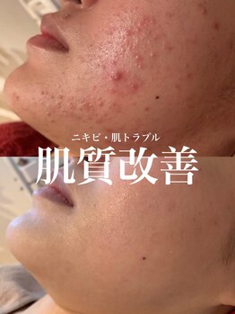 ルアナアイナ(Luana Aina)/ハーブピーリングでニキビケア