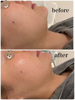 ルカシエ(Le Cacie)/20代女性/脂肪分解液導入