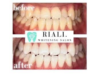 リアリ 宮崎(RIALI.)/プラチナホワイトニング