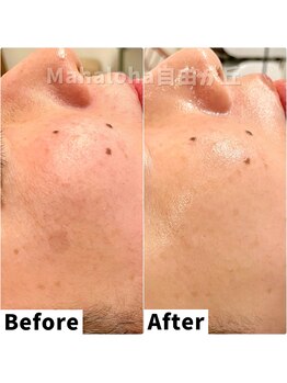 マハロハ 自由が丘(Mahaloha)/【シミケア・くすみ改善施術】