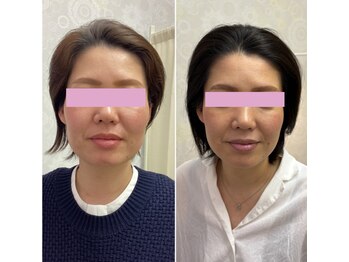 サロン ド グレース(Salon de Grace)/【桑名小顔矯正】 Before After
