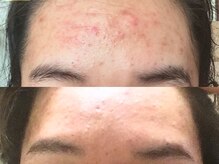 モアスキン 南青山店(MORE SKIN)/ハーブピーリング12回