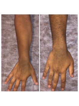 オーシャンズ 谷町四丁目店(OCEANS)/腕脱毛施術症例