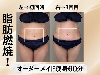 イヨヨ(iyoyo)/【痩身】Before After