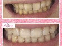 エクシアホワイトニング 姫路店/歯のビフォーアフター