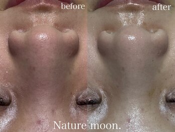 ナチュールムーン(Nature moon.)/毛穴洗浄