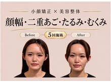 ワンモア 新町店(1MORE)の雰囲気（二重アゴ専門５回でモデル級小顔に！唯一無二やせ見え小顔矯正）