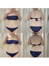 エン ボディアンドフェイシャル(En)/ハイパー＆シェイプ＋腸もみ５回