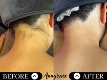 アングレイス(Anngrace)/【全身脱毛うなじ】Before/After