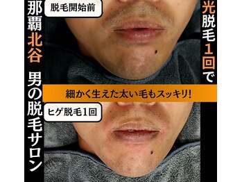 メンズディースタイル 首里店(Men's Dstyle)/那覇メンズ脱毛ヒゲBefore after