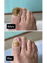 ドクターネイル爪革命 所沢西店/変形、肥厚爪［所沢/狭山ヶ丘］