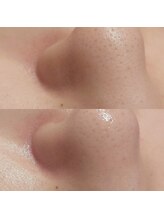 マイフェアレディ 今池(MyFairLady)/毛穴洗浄★ハイドラフェイシャル