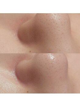 マイフェアレディ 今池(MyFairLady)/毛穴洗浄★ハイドラフェイシャル