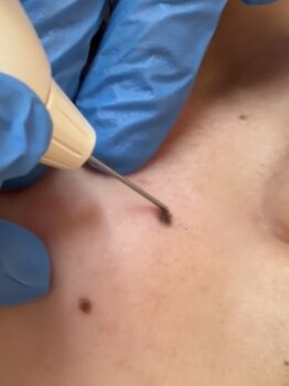 メルポール(Merport)の写真/岡山では希少！最新韓国美容/プラズマフェイシャル導入★ニキビ・しみ・シワ・たるみが気になる方へ＊